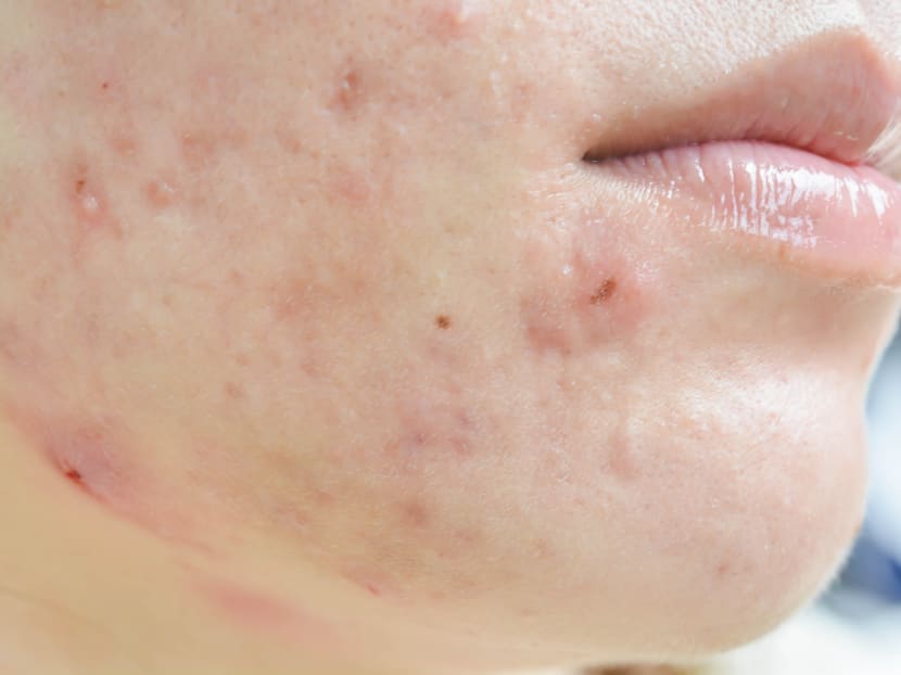 Untreated severe acne may lead to permanent disfiguring scars, but the impact of visible skin issues goes deeper than that.