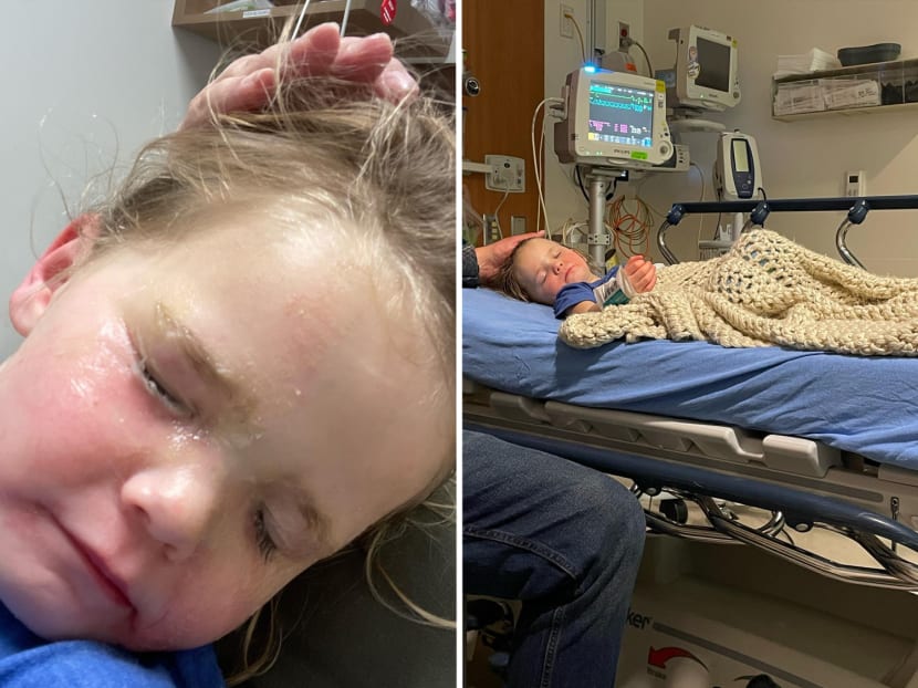 A three-year-old girl (left) could not open her eyes (left) after a bottle of glue "exploded" in her face and she had to be sedated for treatment (right), her mother said.  