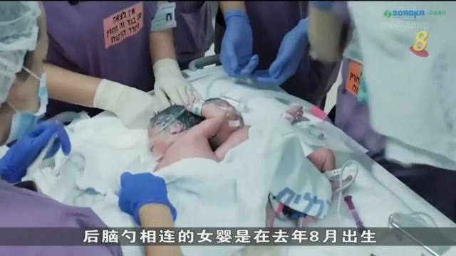 以色列成功为连体婴进行头颅分离手术