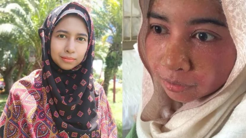 Bergelut dengan penyakit kulit yang teruk, wanita Malaysia ini kuatkan tekad genggam ijazah sarjana sambil besarkan empat anak