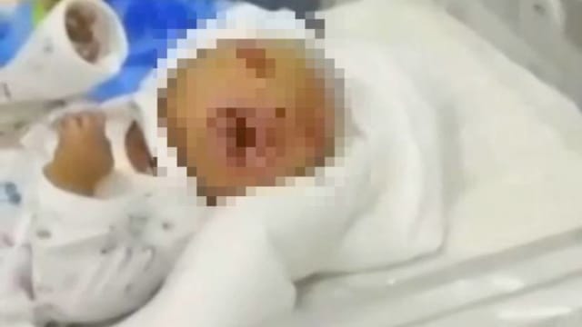 中亚乌国兄妹乱伦产子 男婴患鱼鳞藓症 出生两小时后死