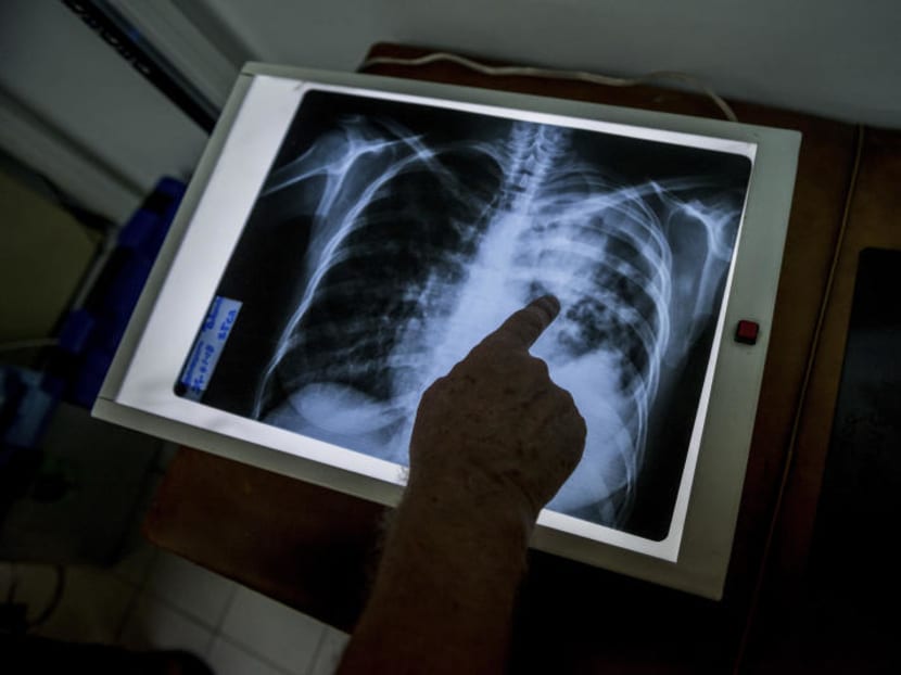 Strategies used in tackling Covid-19 can help to eliminate TB in S’pore Strategies used in tackling Covid-19 can help to eliminate TB in S’pore
