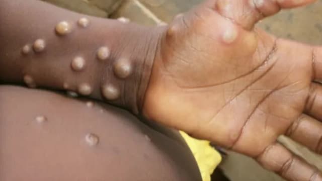 全球猴痘病例 过去一周下跌21%