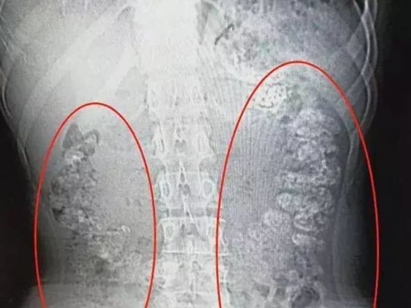 Girl s Viral X ray Shows Undigested Bubble Tea Pearls That Are Actually