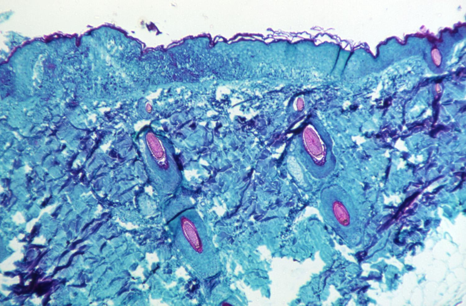 A section of skin tissue, harvested from a lesion on the skin of a monkey, that had been infected with monkeypox virus, is seen at 50x magnification on day four of rash development in 1968. 