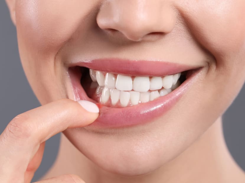 Does rubbing salt on mouth ulcers work? What you need to know about treating canker sores