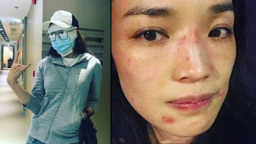 Shu Qi battles with her skin allergies