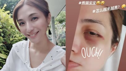 Vivian Lai Now Has A Bruised “Panda Eye” After Falling Down In The Middle Of The Night