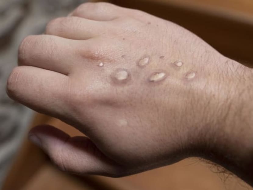 <p>Monkeypox, caused by a virus, causes flu-like symptoms such as fever. A rash that comes on after fever subsides is also a sign and it can take weeks to clear.</p>
