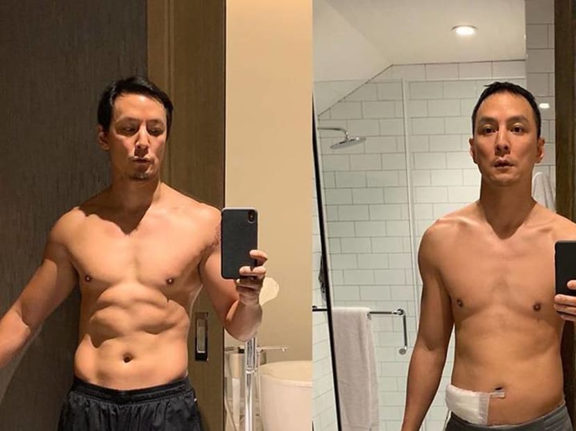 Daniel Wu Shows How His Body Looks Before And After Surgery To Remove  Appendix - Today