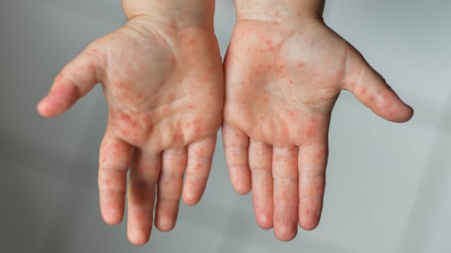 手足口症在马国迅速传播 病例数超越疫情前