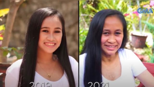 菲律宾少女患罕见怪病 16岁已衰老成50岁模样