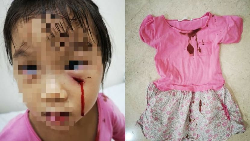 Budak 3 tahun luka 'dalam' selepas diserang burung merak; bukan mangsa pertama