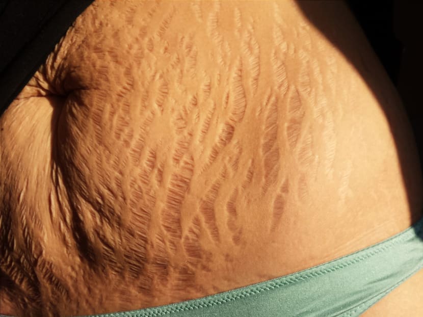 Gallery: Love Your Lines: Stretch marks go viral in support of women