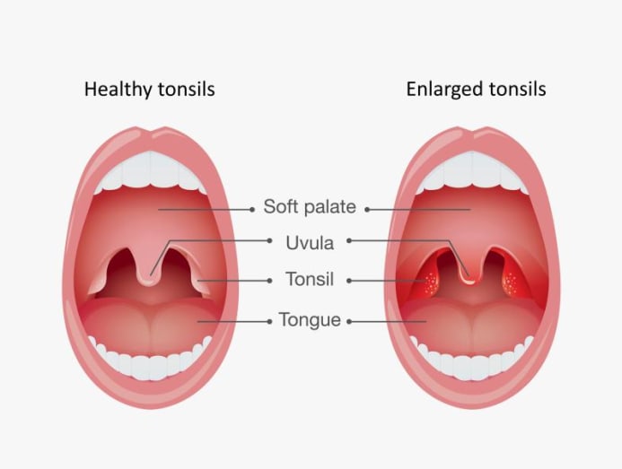 Snoring in children: What's normal and when should you see a doctor ...