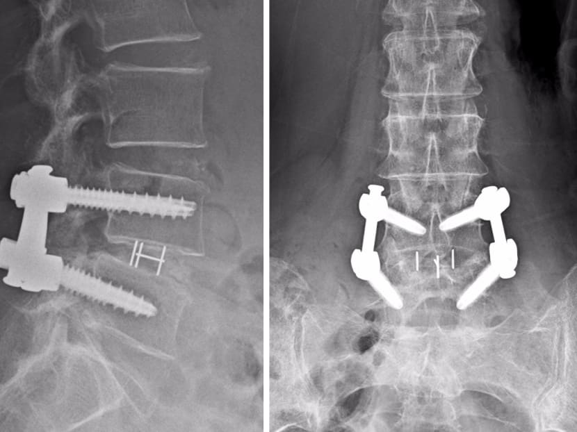 X-rays, post-spinal fusion surgery, of titanium screws and a spacer to fuse bones in the spine.