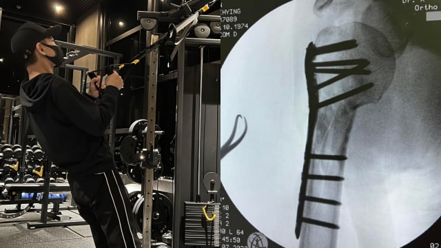 林志颖车祸5个月　首秀“钛合金手臂”X光片