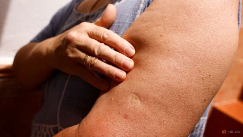 Spain to buy monkeypox vaccine as cases reach 55 Spain to buy monkeypox vaccine as cases reach 55