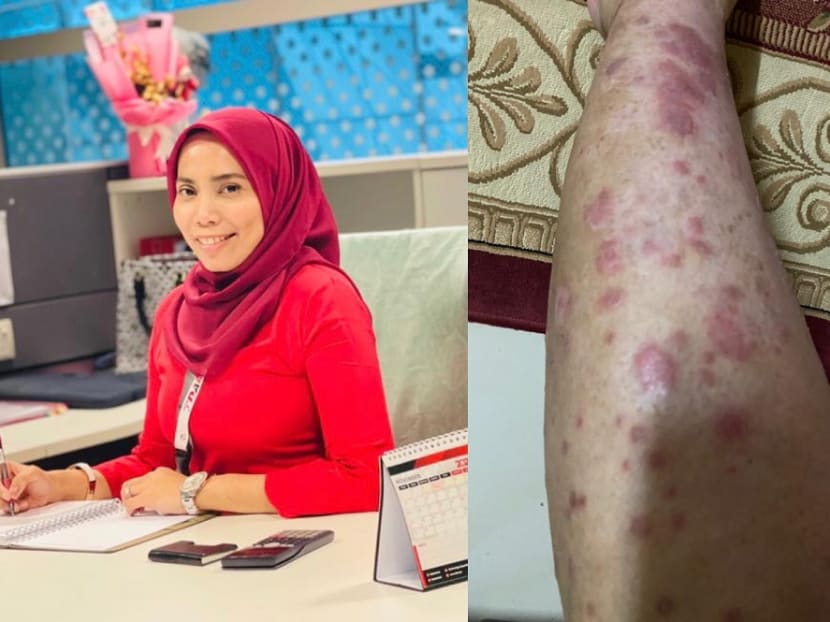 The social stigma caused Marsitah to leave her old job as her psoriasis continued to get worse.