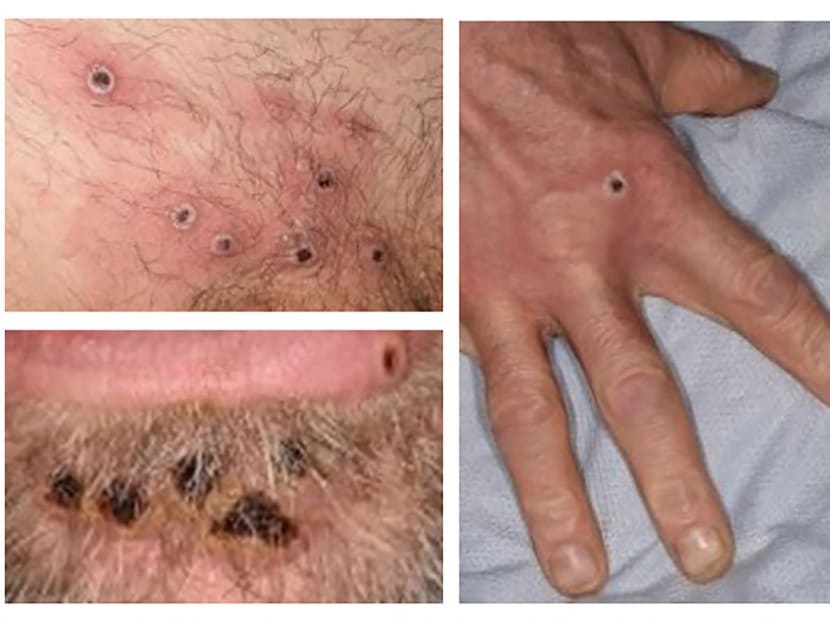 <span style="font-size:16.0pt"><span style="font-family:&quot;Arial&quot;,sans-serif">A handout picture made available by the UK Health Security Agency on June 22, 2022 shows images of monkeypox rash lesions on an infected person. </span></span>