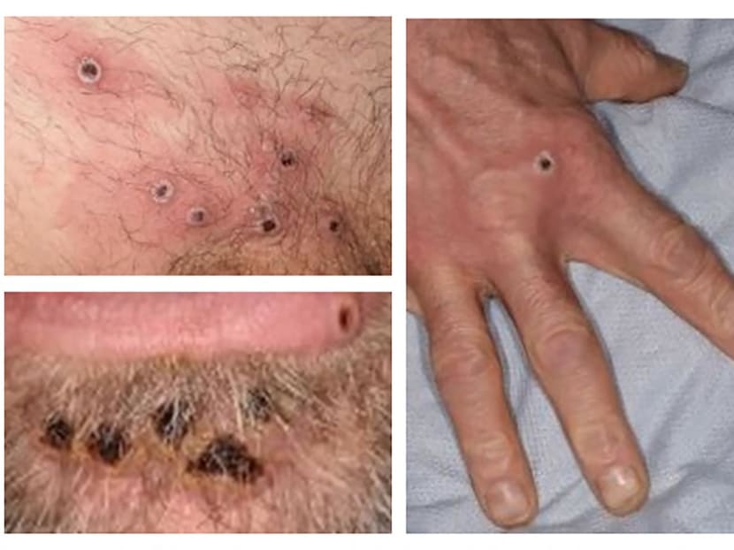 <span style="font-size:16.0pt"><span style="font-family:"Arial",sans-serif">A handout picture made available by the UK Health Security Agency on June 22, 2022 shows images of monkeypox rash lesions on an infected person. </span></span> <span style="font-size:16.0pt"><span style="font-family:"Arial",sans-serif">A handout picture made available by the UK Health Security Agency on June 22, 2022 shows images of monkeypox rash lesions on an infected person. </span></span>
