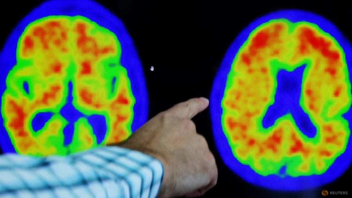 Alzheimer’s diagnosis revamp embraces rating scale similar to cancer