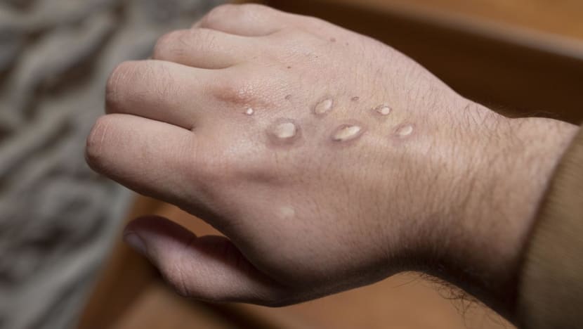 <p>Monkeypox, caused by a virus, causes flu-like symptoms such as fever. A rash that comes on after fever subsides is also a sign and it can take weeks to clear.</p>
