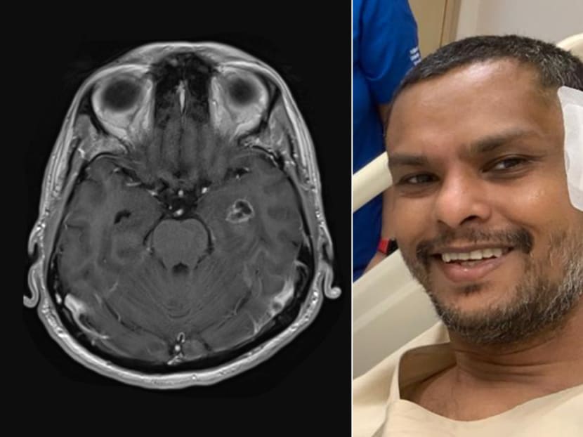 A scan (left) detected a tumour in the temporal lobe of Mr Maideen Sadayan's brain. He had to undergo surgery at National University Hospital (right).
