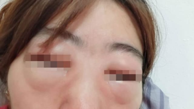 马国女子乱吃药 导致脸部严重肿胀