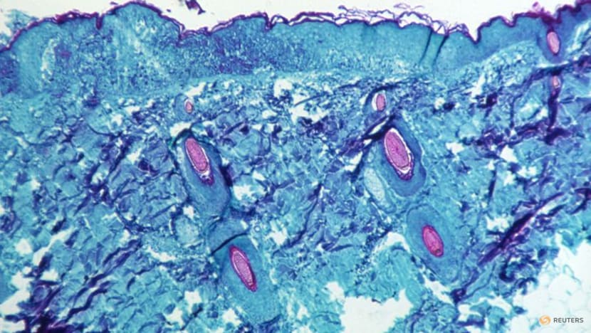 UK designates monkeypox as a notifiable disease UK designates monkeypox as a notifiable disease
