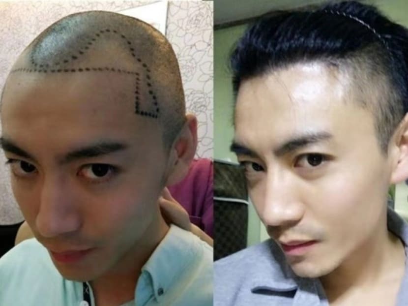 Mr Yin Dongyi, from Beijing, before he had hair transplant surgery (left) and two years after the procedure with a full head of hair (right).