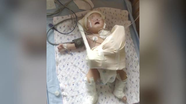 中国男婴出生时被拉断臂丛神经 医院：不拉断就出不来