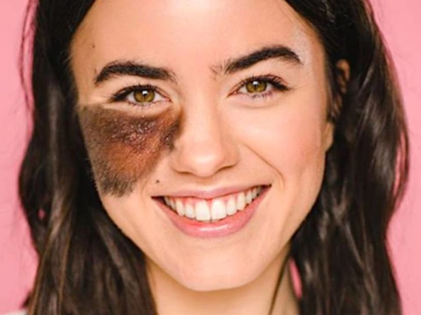 Living with birthmarks: What are the ones you can and cannot remove Living with birthmarks: What are the ones you can and cannot remove