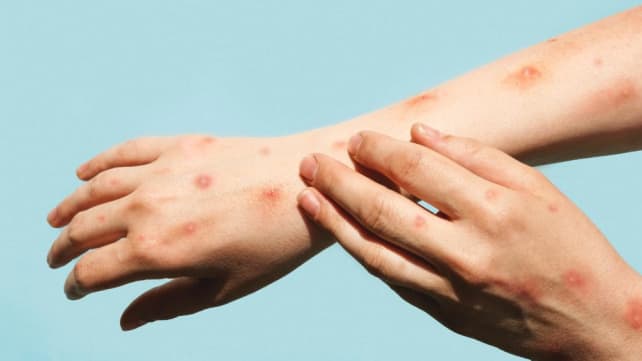 Monkeypox, chickenpox or shingles? Infectious diseases experts explain the difference
