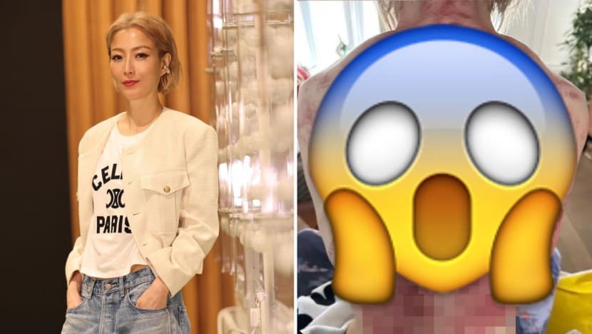 Sammi Cheng Posted A Pic Of Her Post-Gua Sha Back & It Looks Like A Rack Of Meat