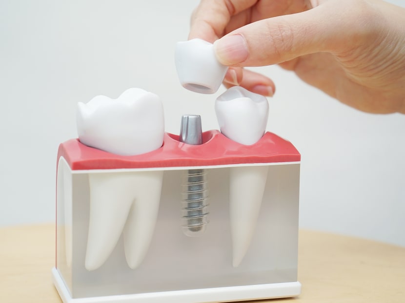 Typically made of titanium, dental implants are surgically embedded into the jawbone to replace a missing tooth root required to anchor an artificial tooth. After an implant fixture integrates into the patient’s natural jawbone, an artificial tooth may be permanently attached to it. Typically made of titanium, dental implants are surgically embedded into the jawbone to replace a missing tooth root required to anchor an artificial tooth. After an implant fixture integrates into the patient’s natural jawbone, an artificial tooth may be permanently attached to it.