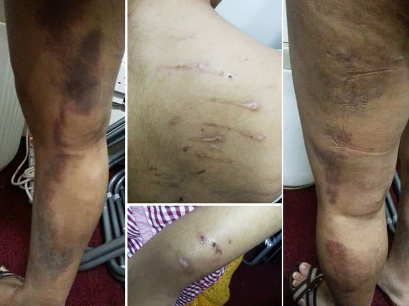 Injuries sustained by domestic helper Ei Phyu Tun after being assaulted by her employer on multiple occasions.