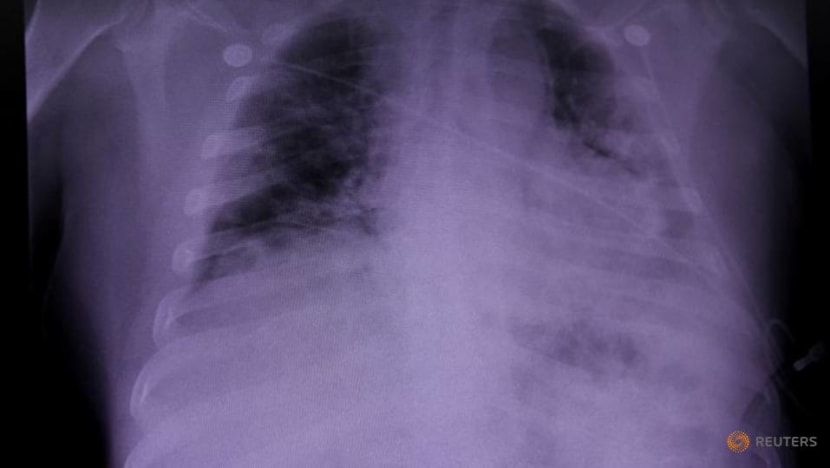 Lung damage found in COVID-19 dead may shed light on 'long COVID': Study Lung damage found in COVID-19 dead may shed light on 'long COVID': Study