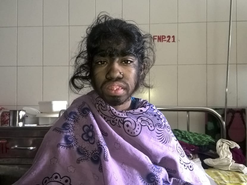 Bangladeshi girl seeks help for rare excess hair condition - TODAY Bangladeshi girl seeks help for rare excess hair condition - TODAY