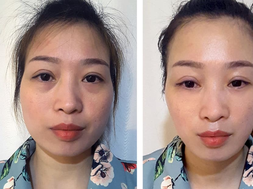 Bioskin's Magic Touch Small Face Treatment has helped Ms Ho Thi Trang achieve facial reduction naturally. Photo: Bioskin