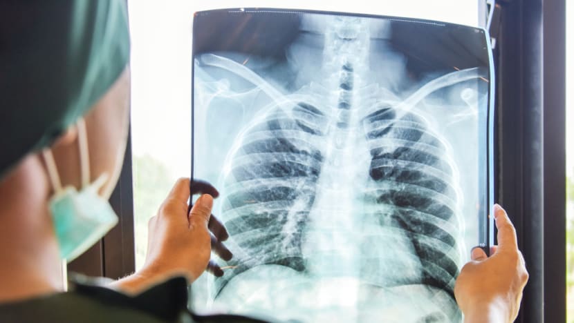 What to know about lung cancer and its common gene mutations What to know about lung cancer and its common gene mutations