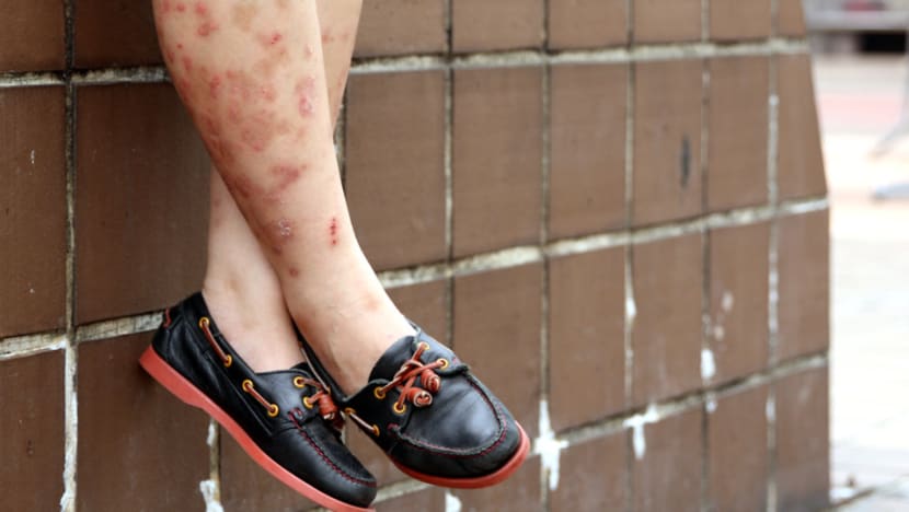 Tackling that itch: Demand for help with skin issues on the rise in Singapore Tackling that itch: Demand for help with skin issues on the rise in Singapore