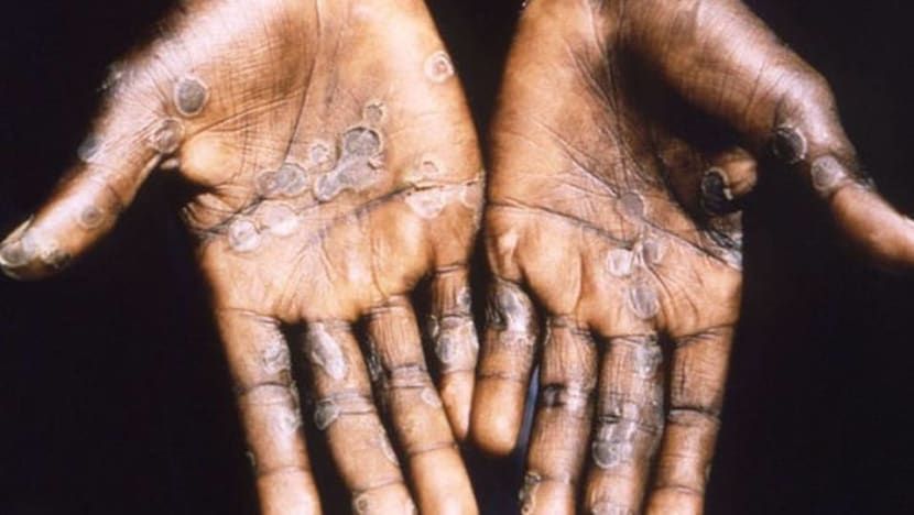 Singapore confirms first case of monkeypox, patient's close contacts quarantined Singapore confirms first case of monkeypox, patient's close contacts quarantined