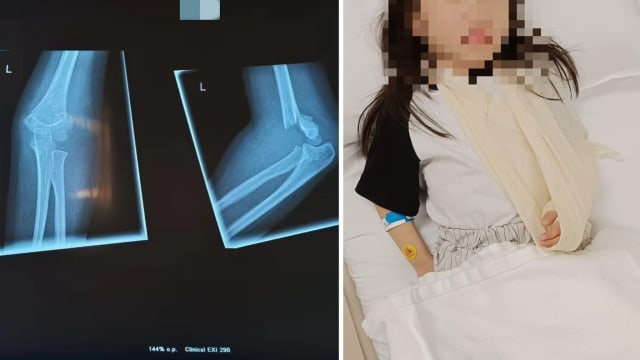 女童被撞伤至骨折 涉事妇女道歉愿赔3500元 