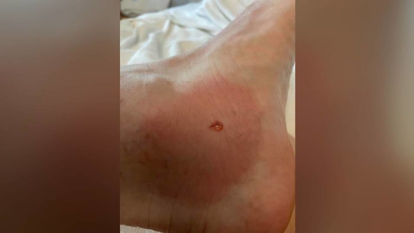 Man stung by stingray at Tanjong Beach in Sentosa Man stung by stingray at Tanjong Beach in Sentosa