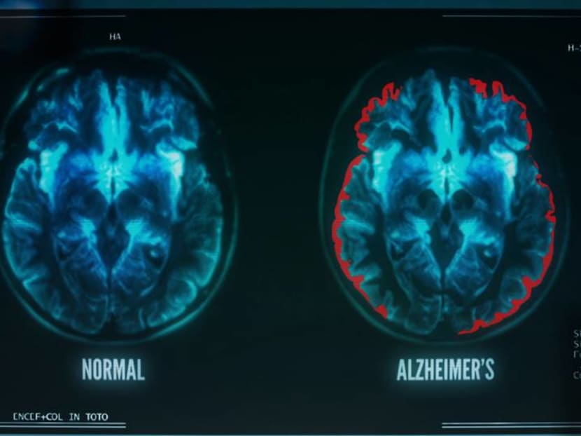 Commentary: Hard to grapple with dementia when early signs are often neglected Commentary: Hard to grapple with dementia when early signs are often neglected