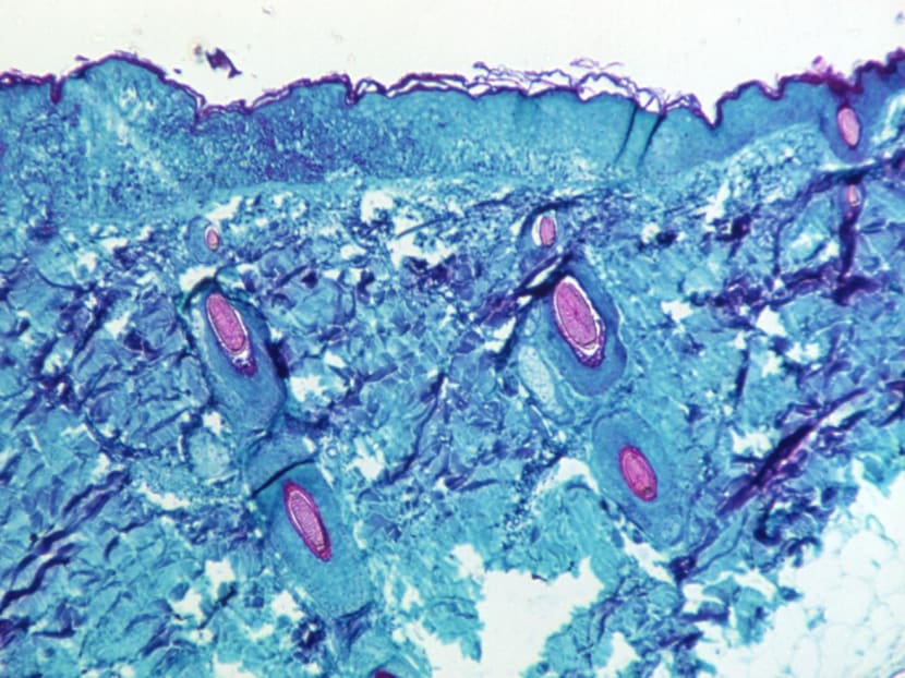 A section of skin tissue, harvested from a lesion on the skin of a monkey, that had been infected with monkeypox virus, is seen at 50X magnification on day four of rash development in 1968. 