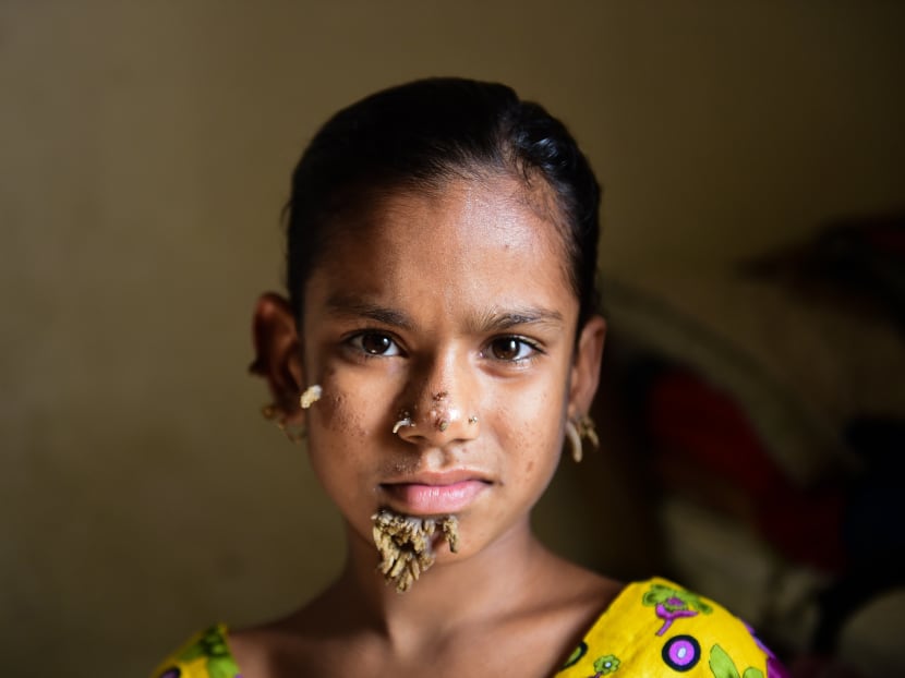 Bangladeshi patient Sahana Khatun, 10, poses for a photograph at the Dhaka Medical College and Hospital. A young Bangladeshi girl with bark-like warts growing on her face could be the first female ever afflicted by so-called "tree man syndrome", doctors studying the rare condition said January 31.  Photo: AFP
