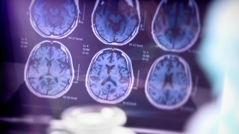 Alzheimer's drug from Eisai and Biogen slows cognitive decline, side-effects in focus Alzheimer's drug from Eisai and Biogen slows cognitive decline, side-effects in focus