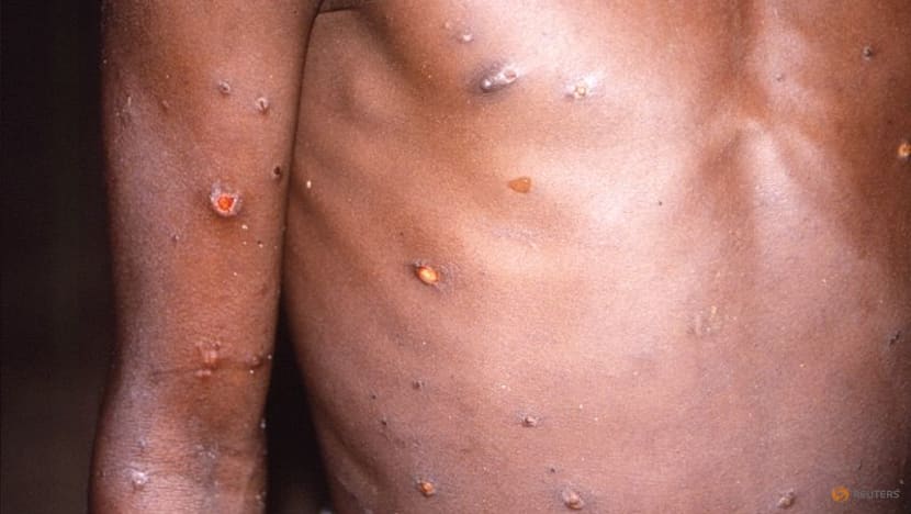 Explainer: Why monkeypox cases are rising in Europe Explainer: Why monkeypox cases are rising in Europe